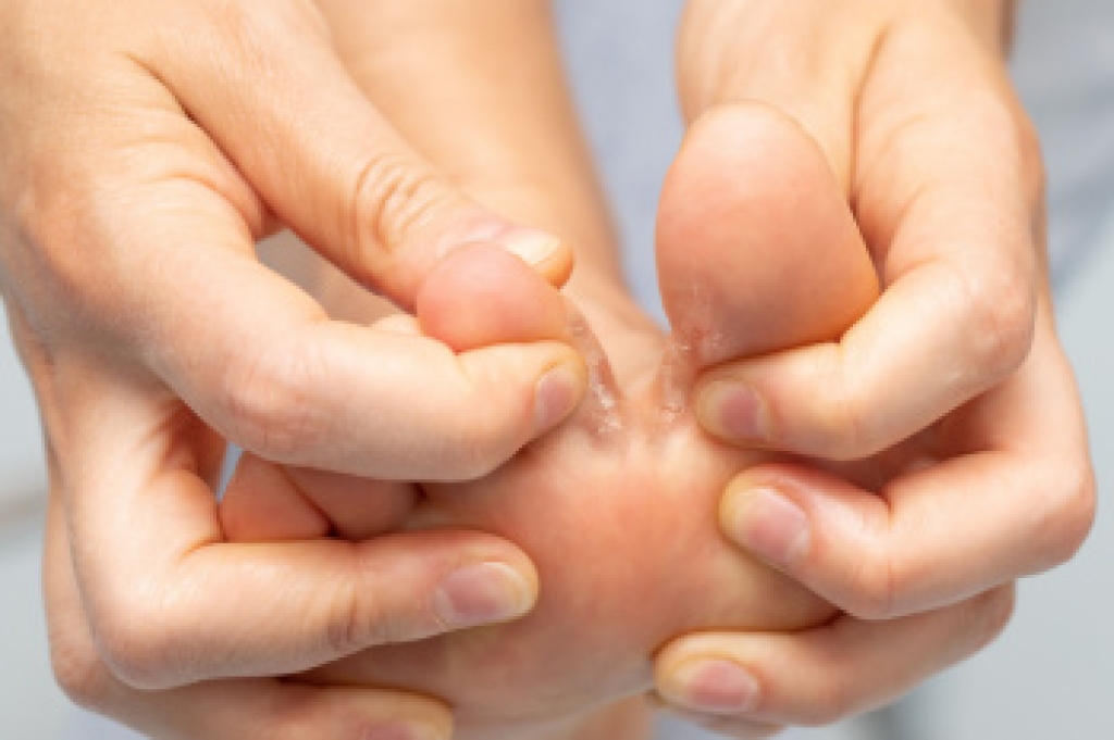 Finding Lasting Relief From Athlete’s Foot