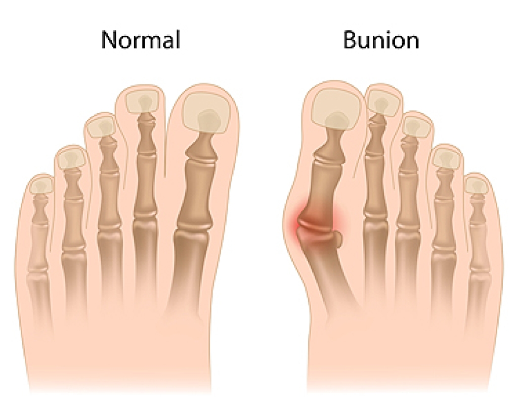 Bunion Basics and Foot Changes