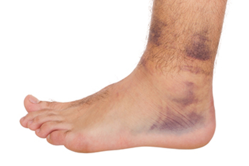Podiatric Treatment for Ankle Sprains