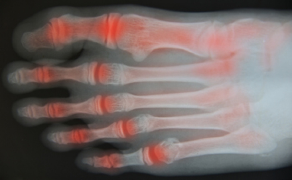 Understanding Foot Arthritis and Its Impact on Mobility