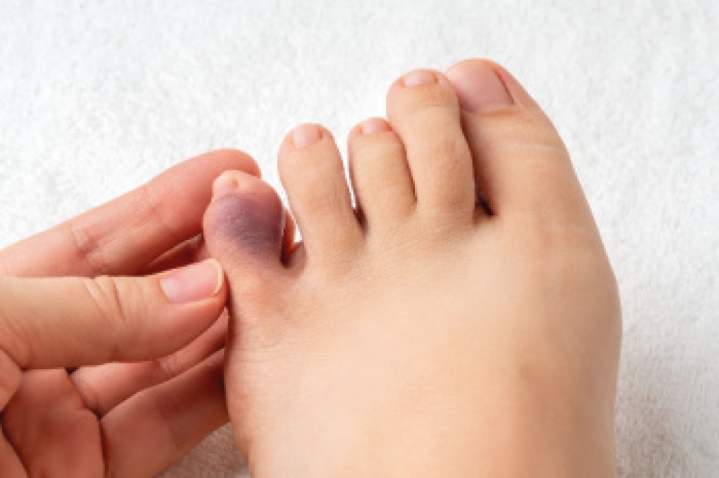 Signs and Causes of a Broken Pinky Toe