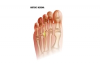 Navigating Foot Pain and Discomfort From Morton’s Neuroma