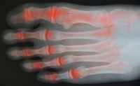 Arthritis and Your Feet